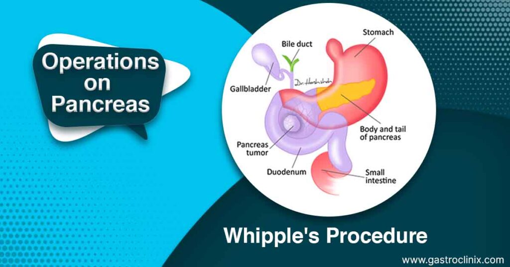 13. Whipples procedure blog