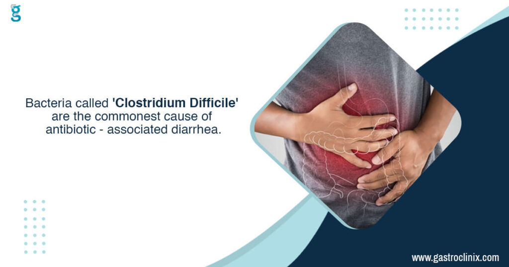 Best doctor for Antibiotic associated diarrhoeaC.difficile infection treatment