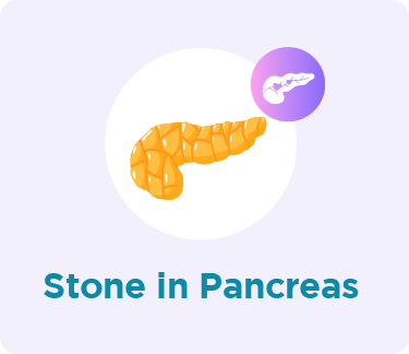 Pancreas Stone in Pancreas