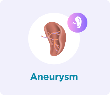 Spleen Aneurysm