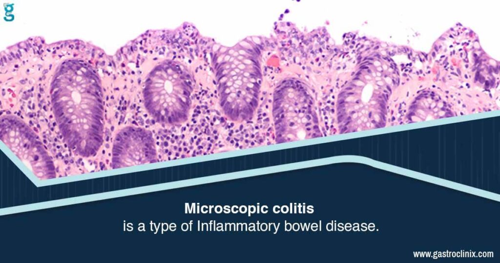 Treatment for Microscopic Colitis