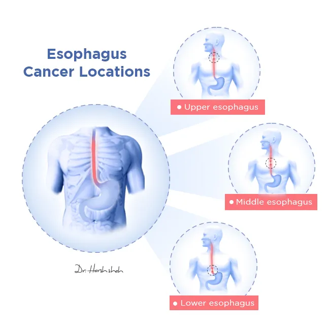Esophageal Cancer Locations