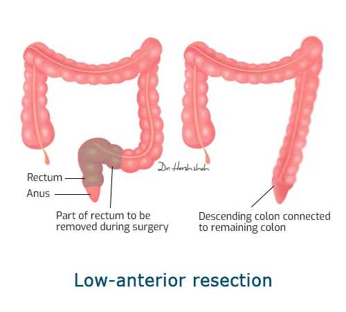 Low-anterior-resection