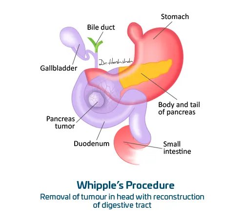 Whipple’s-Procedure for pancreas cancer