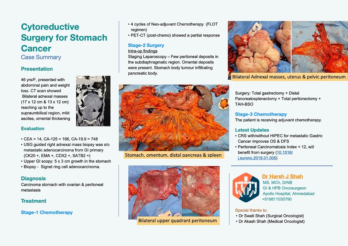 Case reports of stomach cancer by Dr harsh shah - oncologist in ahmedabad (Cytoreductive Surgery for stomach cancer) (1)