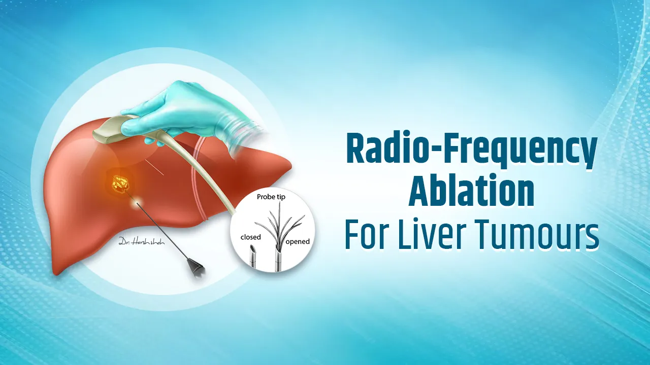Radiofrequency Ablation (RFA) for Liver Tumours