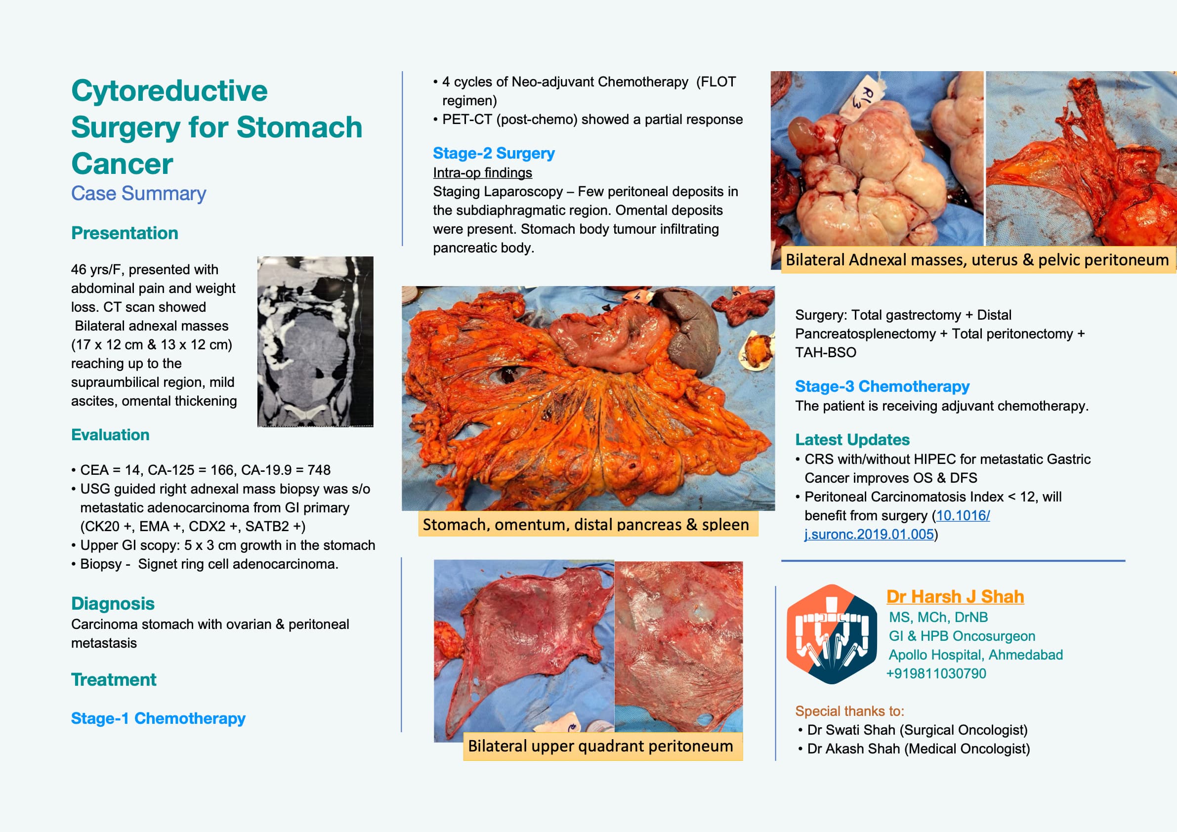 Cytoreductive Surgery for Stomach Cancer - Case Summary