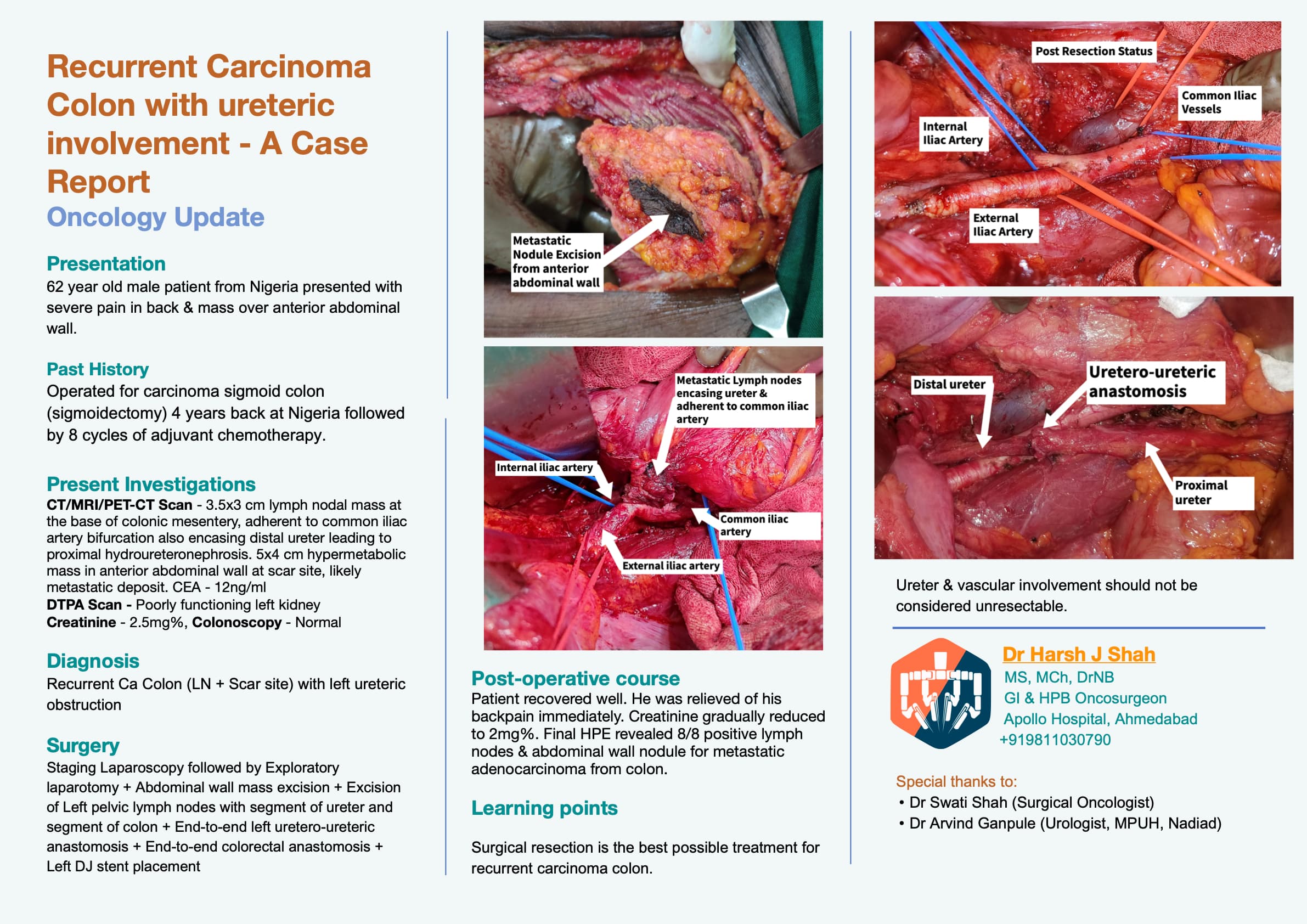 Recurrent Carcinoma Colon with ureteric involvement - A Case Report