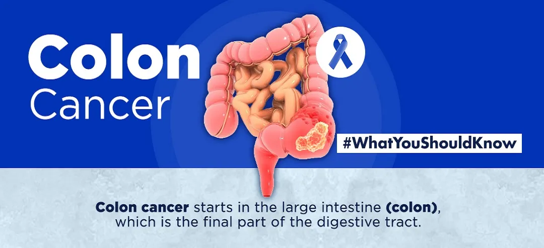 Colon cancer - infographic - What you should know