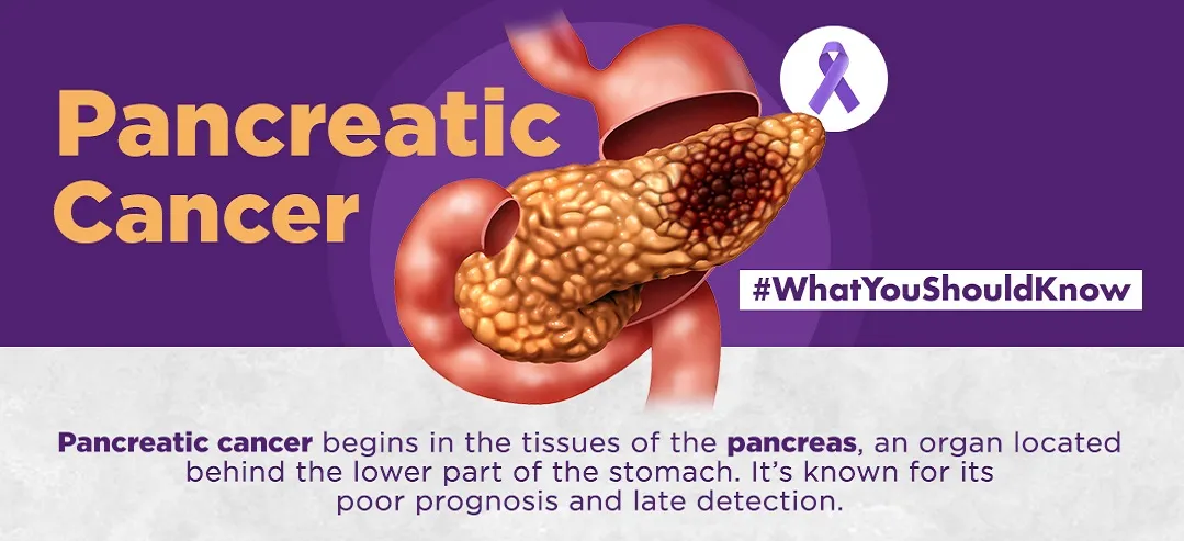 Pancreatic cancer - infographic - What you should know