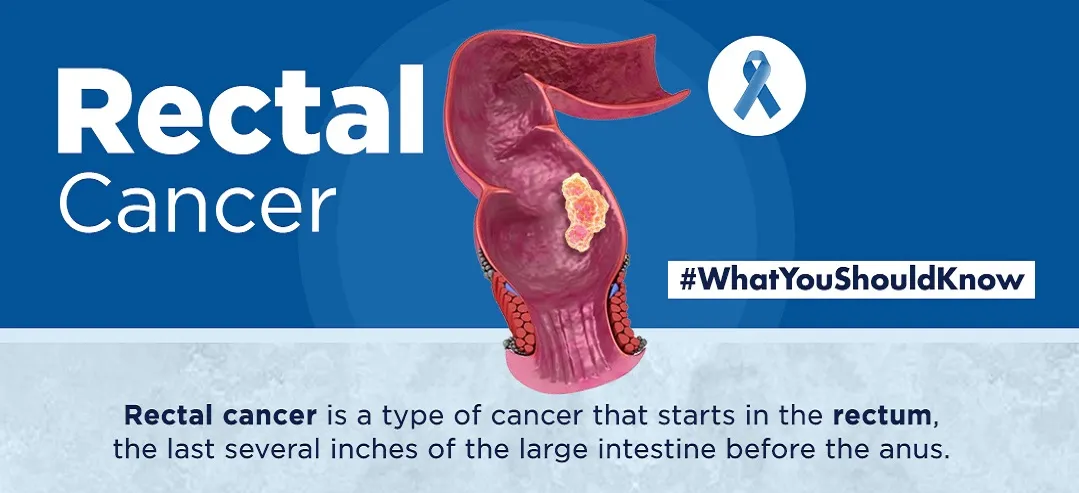 Rectal cancer - infographic - What you should know