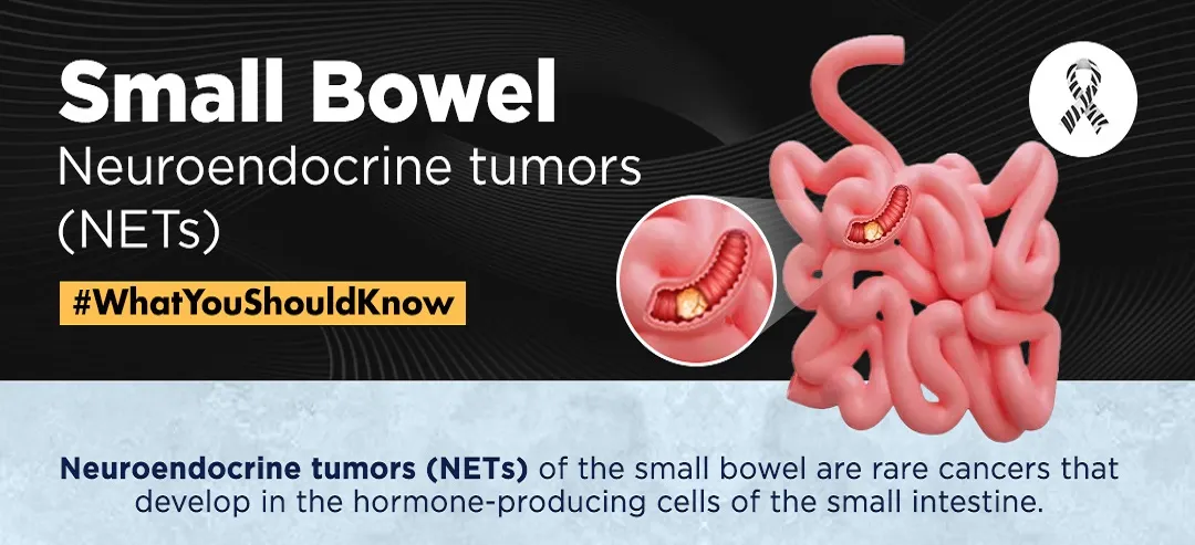 Small Bowel NETs - infographic - What you should know