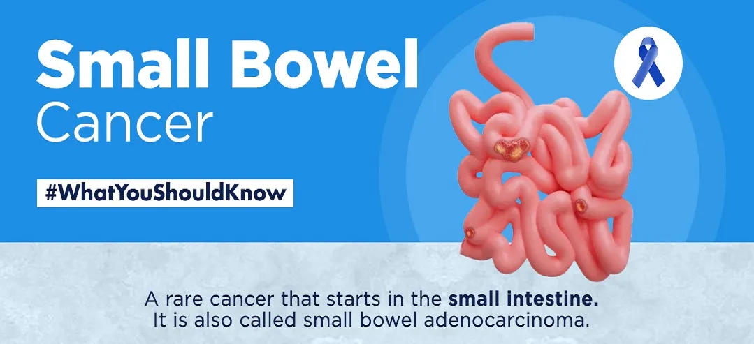 Small bowel cancer - infographic - What you should know