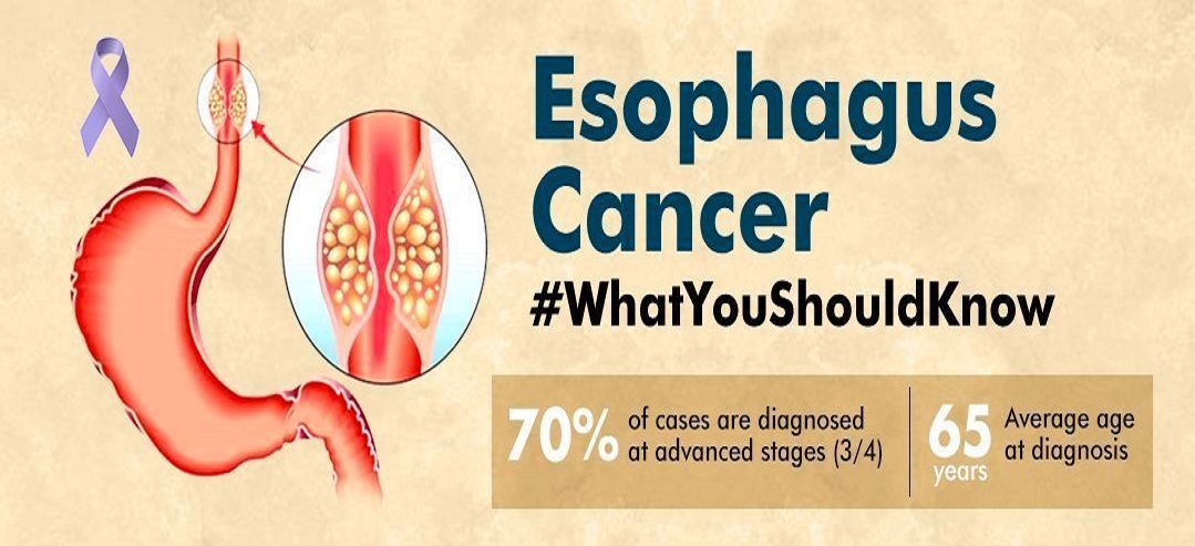 Esophageal Cancer Infographic Image