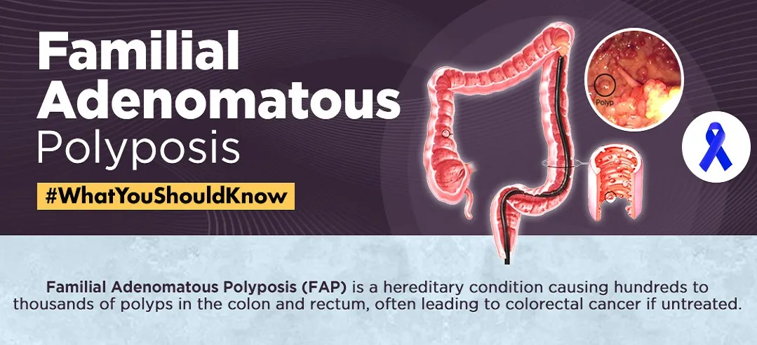 Familial Adenomatous Polyposis 1