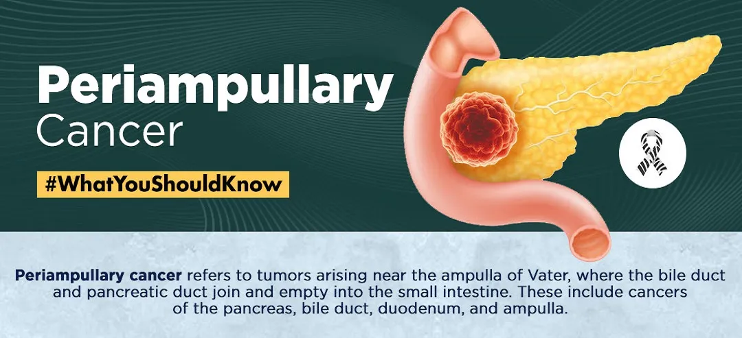 Periampullary Cancer 1