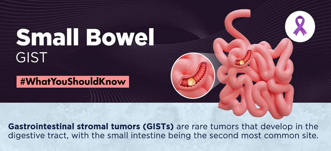 Small Bowel GIST