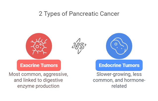 2 types of pancreatic cancer