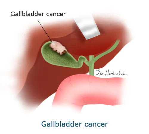 Gallbladder_Cancer_-_What_is_gallbladder_cancer