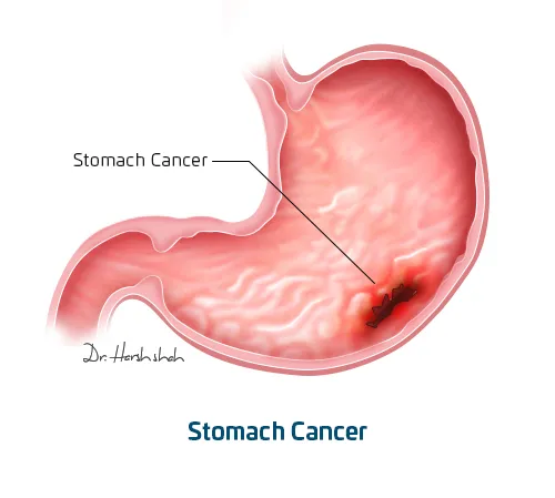 Stomach_Cancer_-_What_is_stomach_cancer